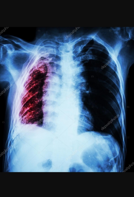 La atelectasia pulmonar causas síntomas remedio natural