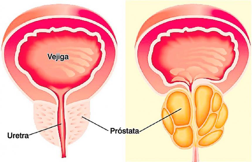    Cáncer de Próstata remedio natural