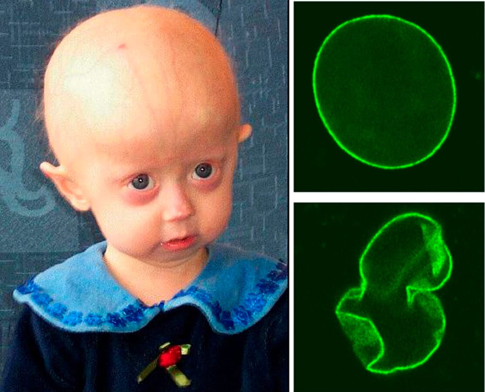 Progeria Síntomas Tratamiento Natural