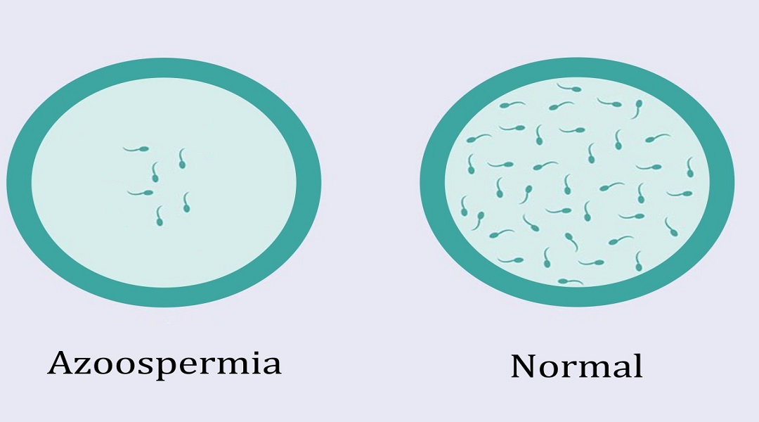 70- Azoospermia Tratamiento natural para curar azoospermia