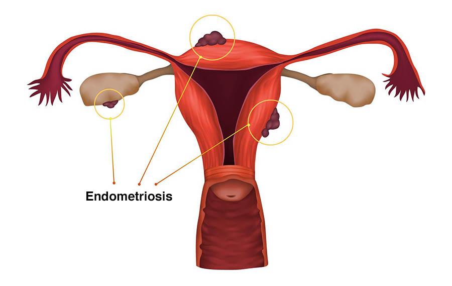 Remedios caseros para la endometriosis
